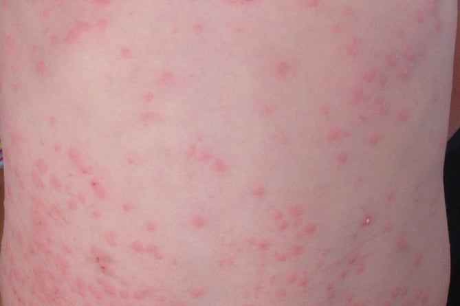 Measles